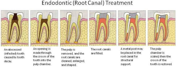 root-canal-steps-orange-county