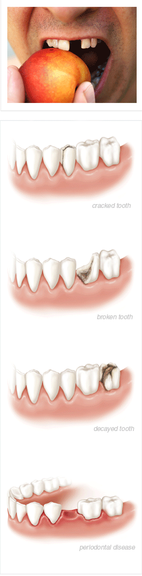 tooth-extraction-cause