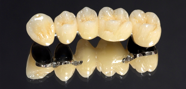 Metal Ceramics crown sodepur -Agarpara dental clinic