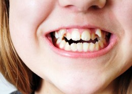 malocclusion of children smileline dental clinic